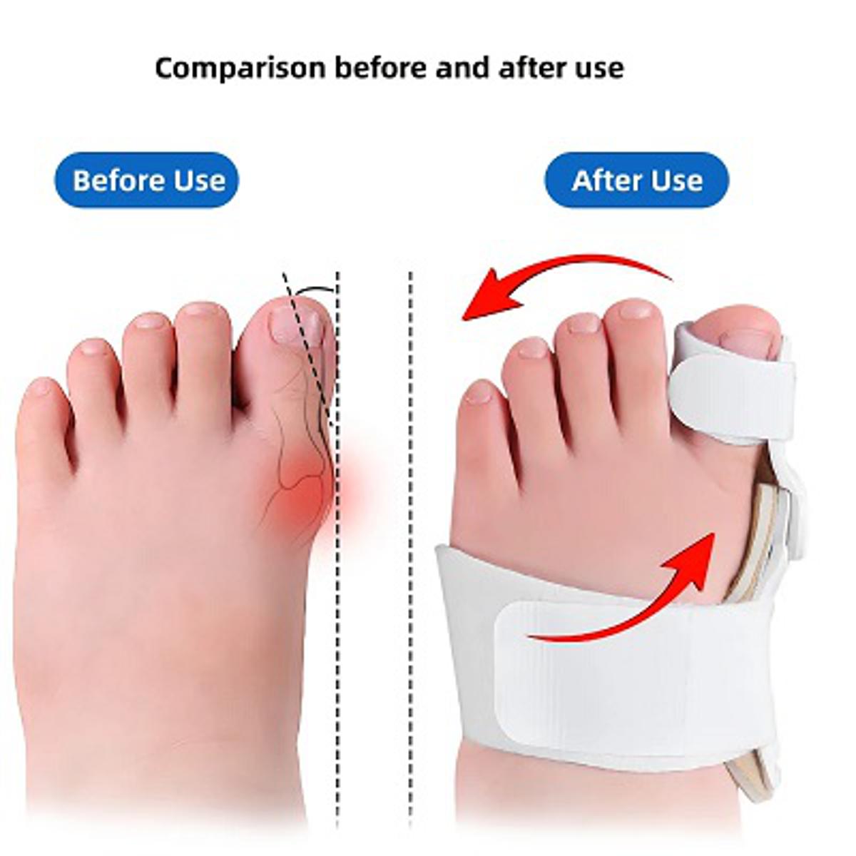 Pain Relief Bunion Toe Corrector
