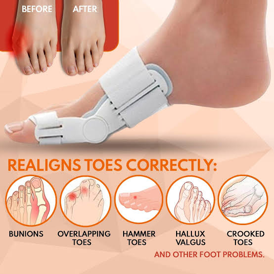 Pain Relief Bunion Toe Corrector